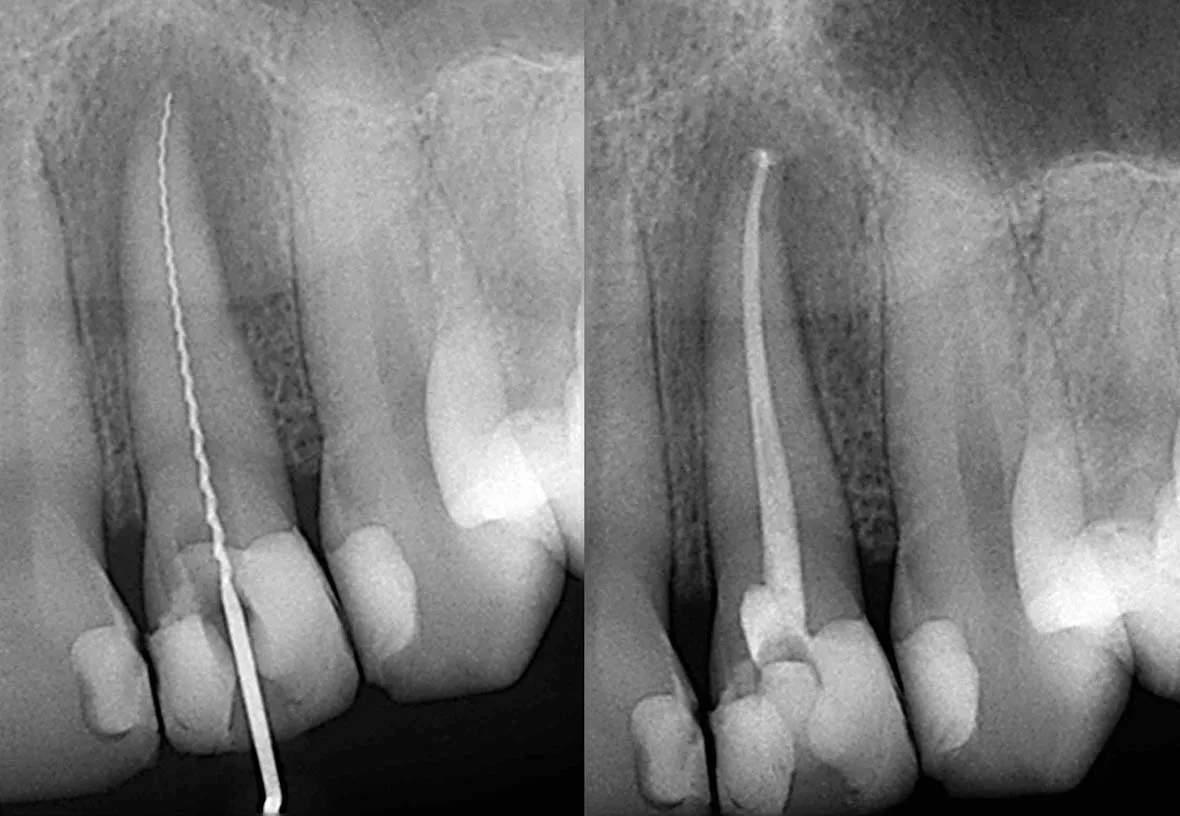 root canal image